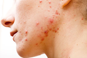 use oregano oil to treat cystic acne